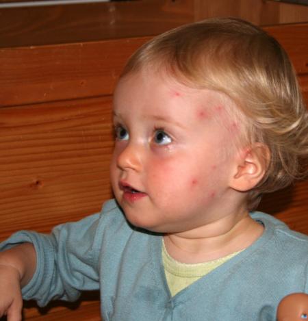 Pauvre Maya d�vor�e par les moustiques !